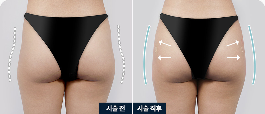힙딥필러 엉덩이모양 울퉁불퉁 힙딥필러 전후