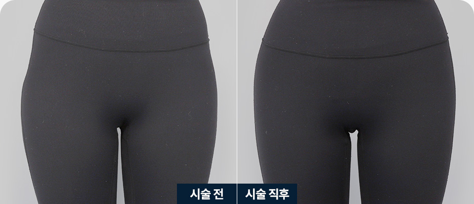 힙딥필러 힙딥 체형 힙딥필러 전후