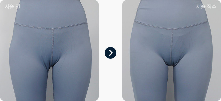 힙딥필러 전후사진 힙딥필러후기