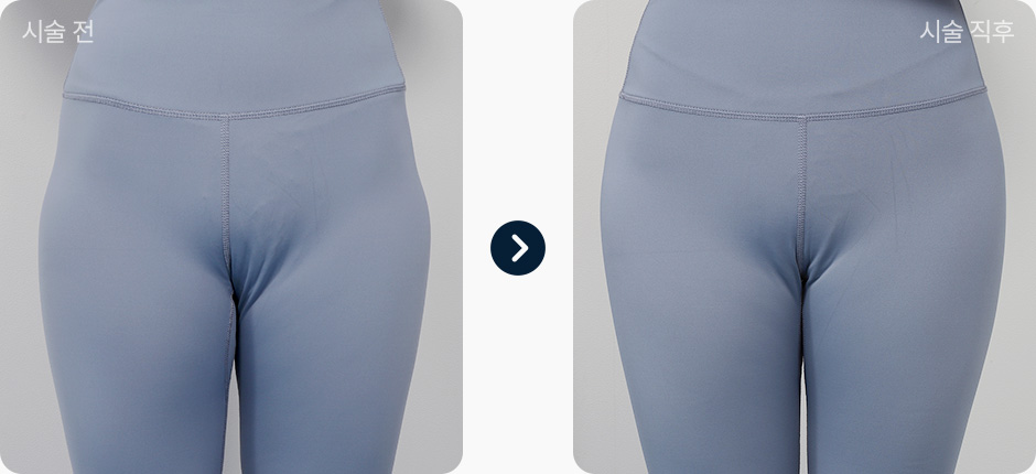 힙딥필러 전후사진 힙딥필러후기