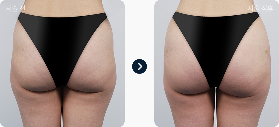 힙딥필러 전후사진 힙딥필러후기