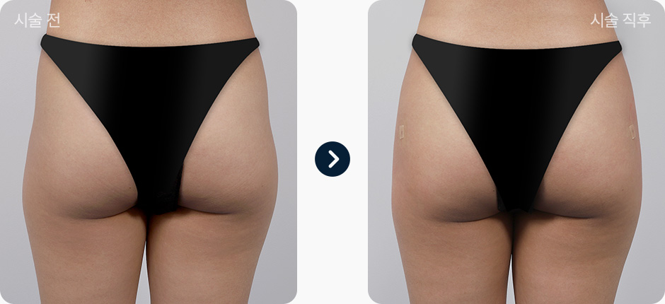 힙딥필러 전후사진 힙딥필러후기