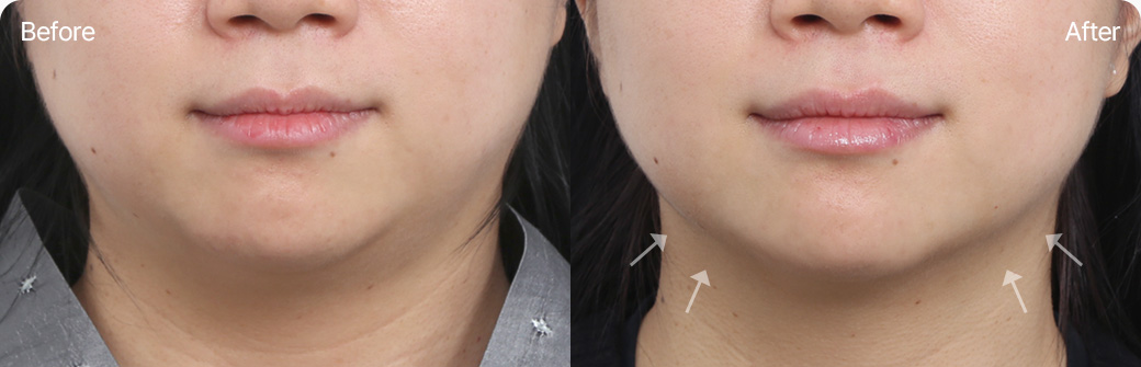 인모드 전후사진 인모드후기 MINI FX FORMA