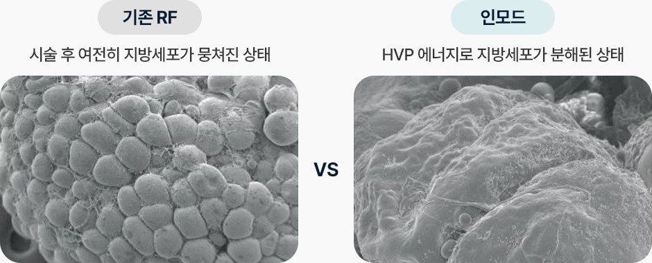 인모드 기존RF 시술 후에도 뭉쳐진 지방세포 인모드 HVP 에너지로 지방세포 분해