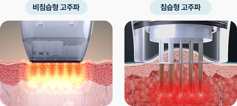 포텐자 비침습형 고주파 침습형 고주파