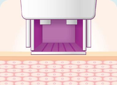 써마지FLX 시술방법 시술팁 피부위에 안착