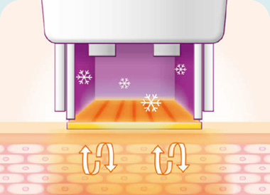 써마지FLX 시술방법 고주파 열에너지 침투 쿨링 시스템 유지