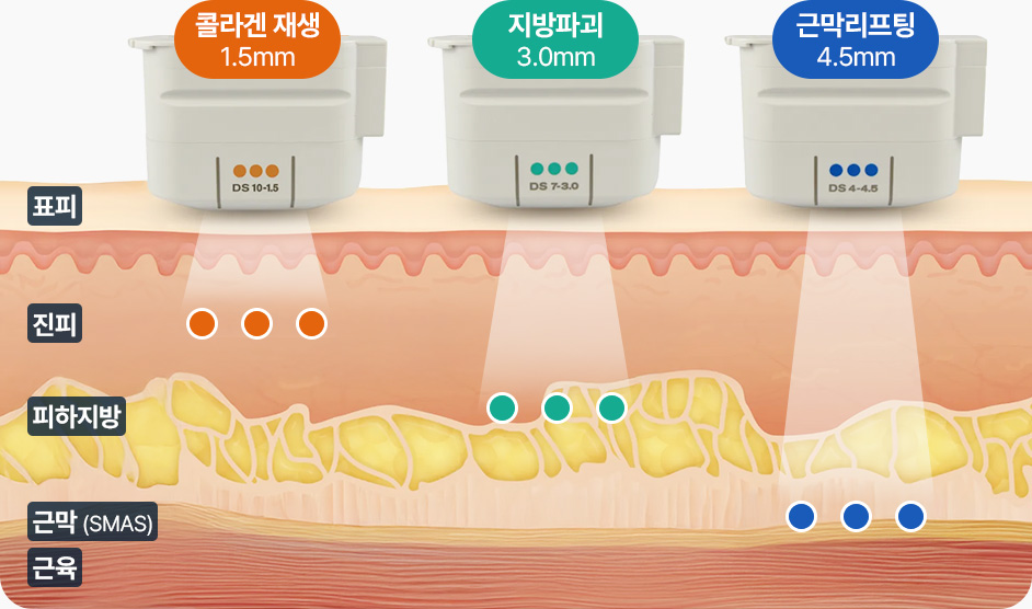 울쎄라 전용팁 1.5mm 콜라겐 재생 3.0mm 지방파괴 4.5mm 근막리프팅