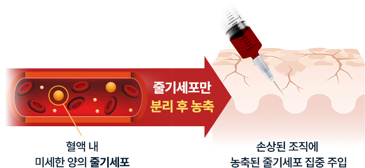 원더풀 줄기세포 주요성분 줄기세포 성장인자 백혈구 혈소판 SDF-1α 손상된 세포재생 및 피부 근복회복 유도 주름완화, 피부톤과 탄력개선 피부재생효과 약6개월이상지속력