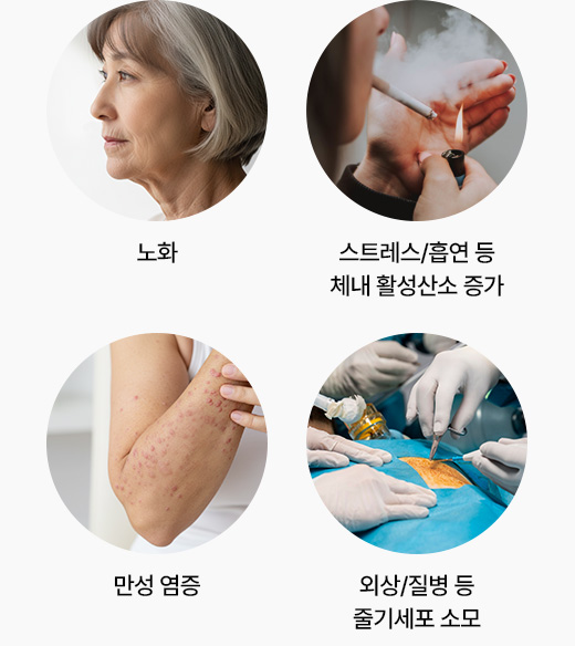 원더풀 줄기세포 감소원인 노화 스트레스 흡연 체내활성산소증가 만성염증 외상 질병등 줄기세포소모