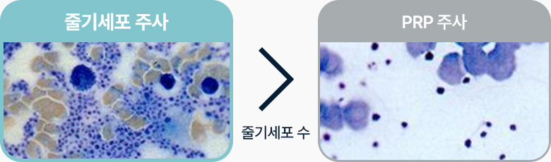 원더풀 줄기세포 PRP보다 줄기세포 수가 많음